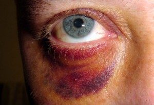 Foto mostrando rosto de mulher agredida