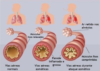 Anatomia da Asma, o que é a asma